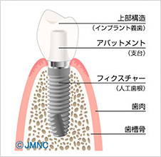 インプラントとは