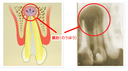 嚢胞（のうほう）のイメージ